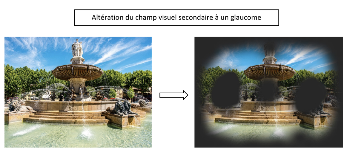 Altération du champ visuel secondaire à un glaucome